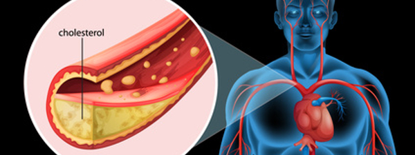 dislipidemia dislipidemia